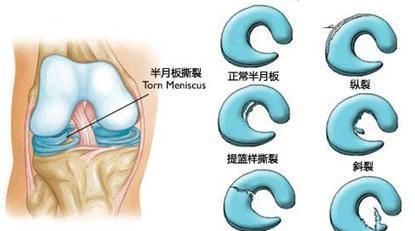 人体最容易受伤的关节是哪个关节图10